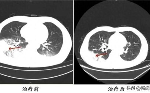 接连两人确诊，严重者可致死！几乎家家在用，紧急提醒→-确诊死亡病例